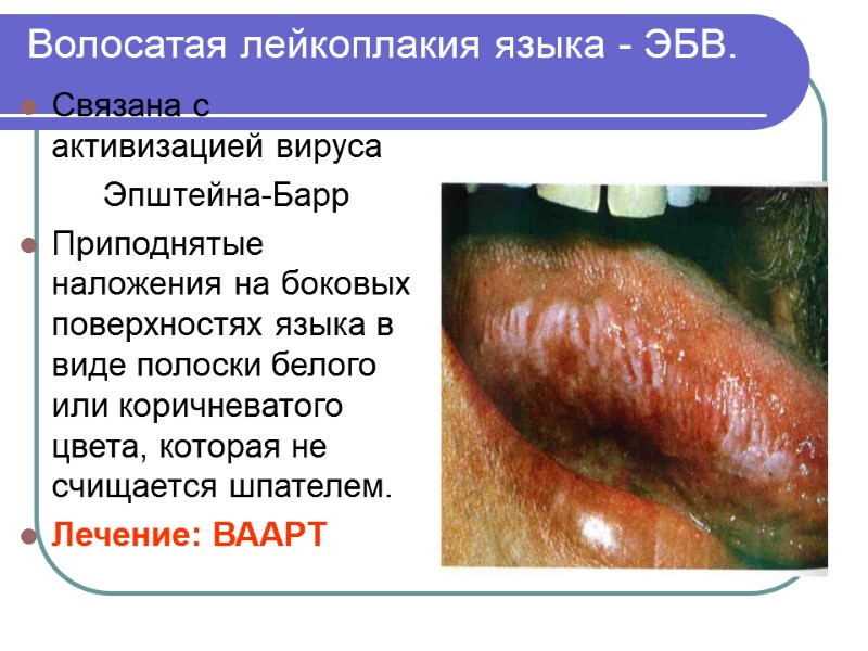 Волосатая лейкоплакия языка - ЭБВ. Связана с активизацией вируса     
